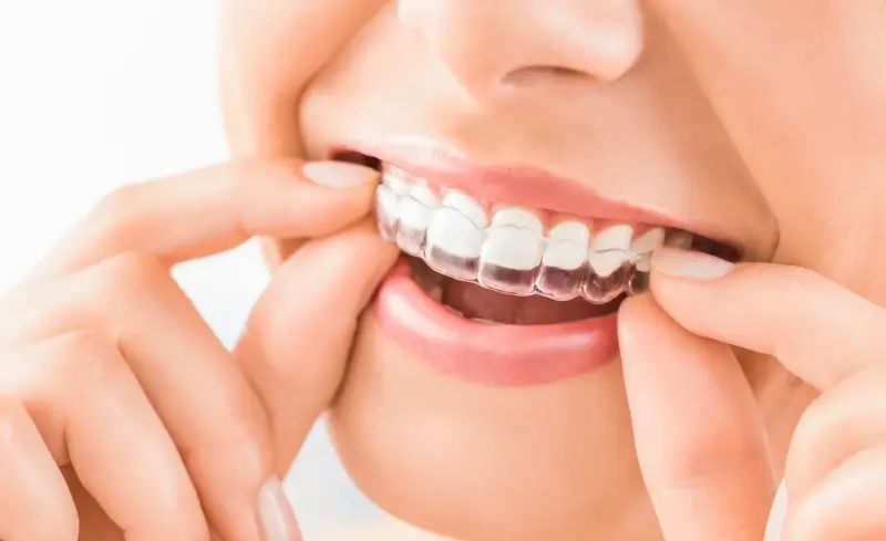 Czy noszenie nakładek Invisalign boli?
